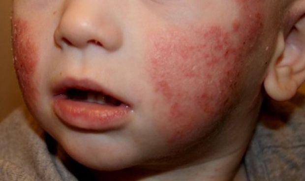 Cuidados de la piel del niño con dematitis  atópica   