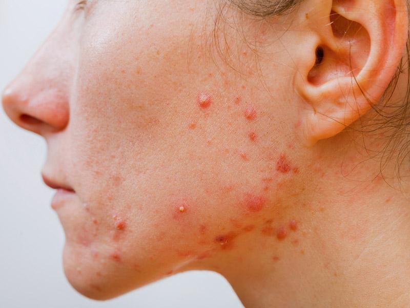 Cuidados de la piel del adolescente: el acné.