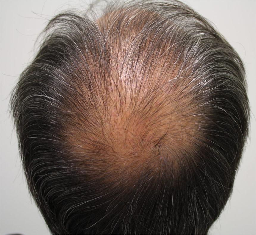Minoxidil oral para tratar alopecias