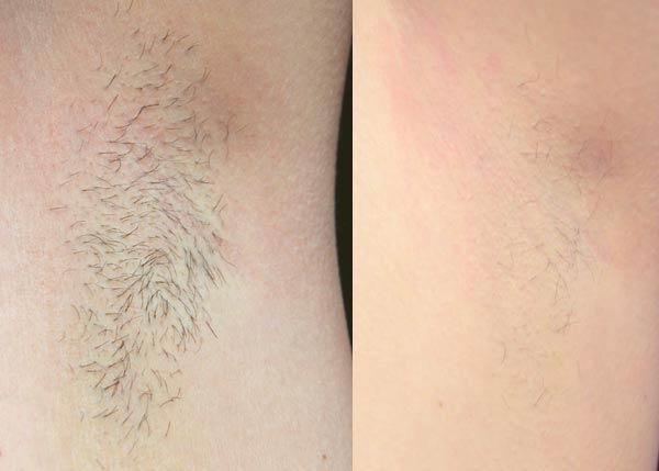 Depilación Láser: Antes de que tu piel esté bronceada