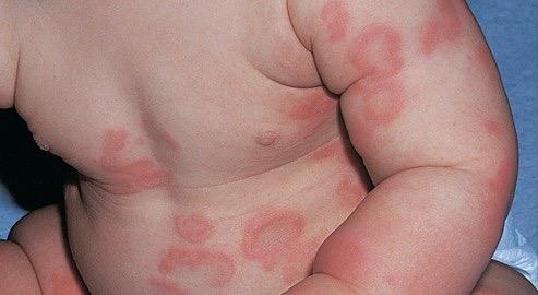 Consejos para cuidar la dermatitis atópica de tu niño