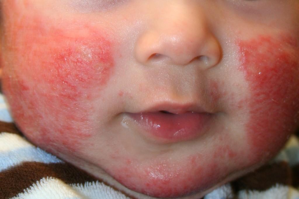 Dermatitis atópica: consejos prácticos para el cuidado de la piel.