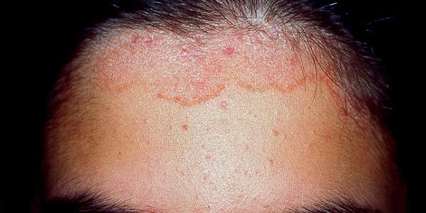 Dermatitis seborreica: patología frecuente en la población general