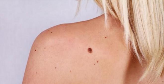 ¿Como podemos prevenir el melanoma?