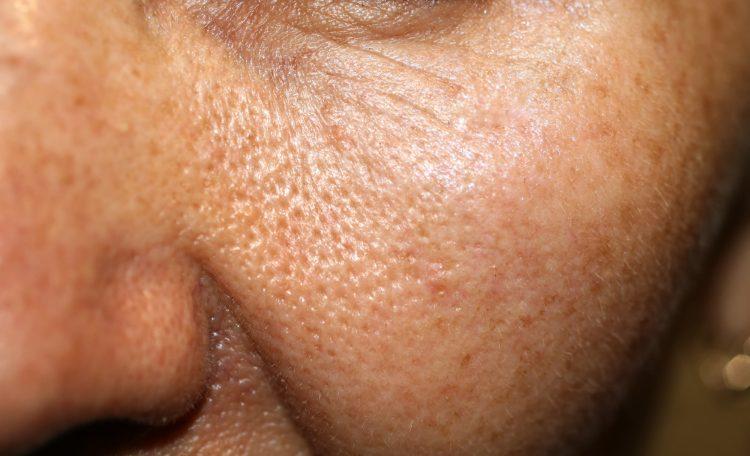 ¿ Cómo tratar los poros dilatados?