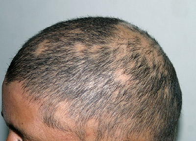 Tratamiento alopecia Clínica Dermatología Doctor Menéndez en Cuenca