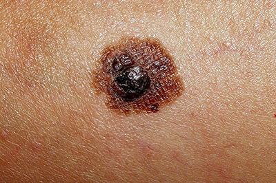 Tratamiento y detección precoz de melanomas en  Clínica Dermatología Doctor Menéndez en Cuenca