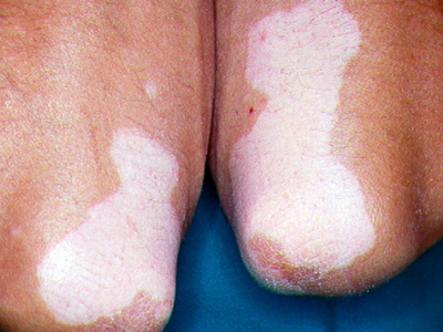 Tratamiento de vitiligo falta de pigmentación en piel Clínica Dermatología Doctor Menéndez en Cuenca