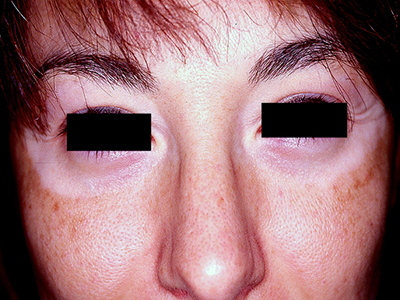 Tratamiento vitiligo falta de pigmentación en piel  Clínica Dermatología Doctor Menéndez en Cuenca